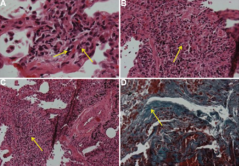 Histopathology images of transbronchial lung biopsy under low and high power field. (A) Multifocal ill-defined granulomas (arrows). (B) Acute on chronic inflammation (arrow). (C) Perivascular granuloma (arrow) and (D) Interstitial fibrosis (arrow).